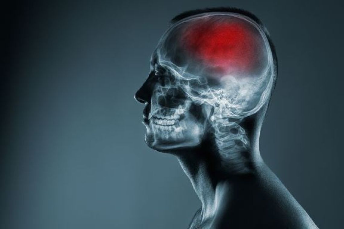 Εγκεφαλικό | Μεγαλύτερος ο κίνδυνος ενός επεισοδίου για όσους χρησιμοποιούν αντιεμετικά φάρμακα