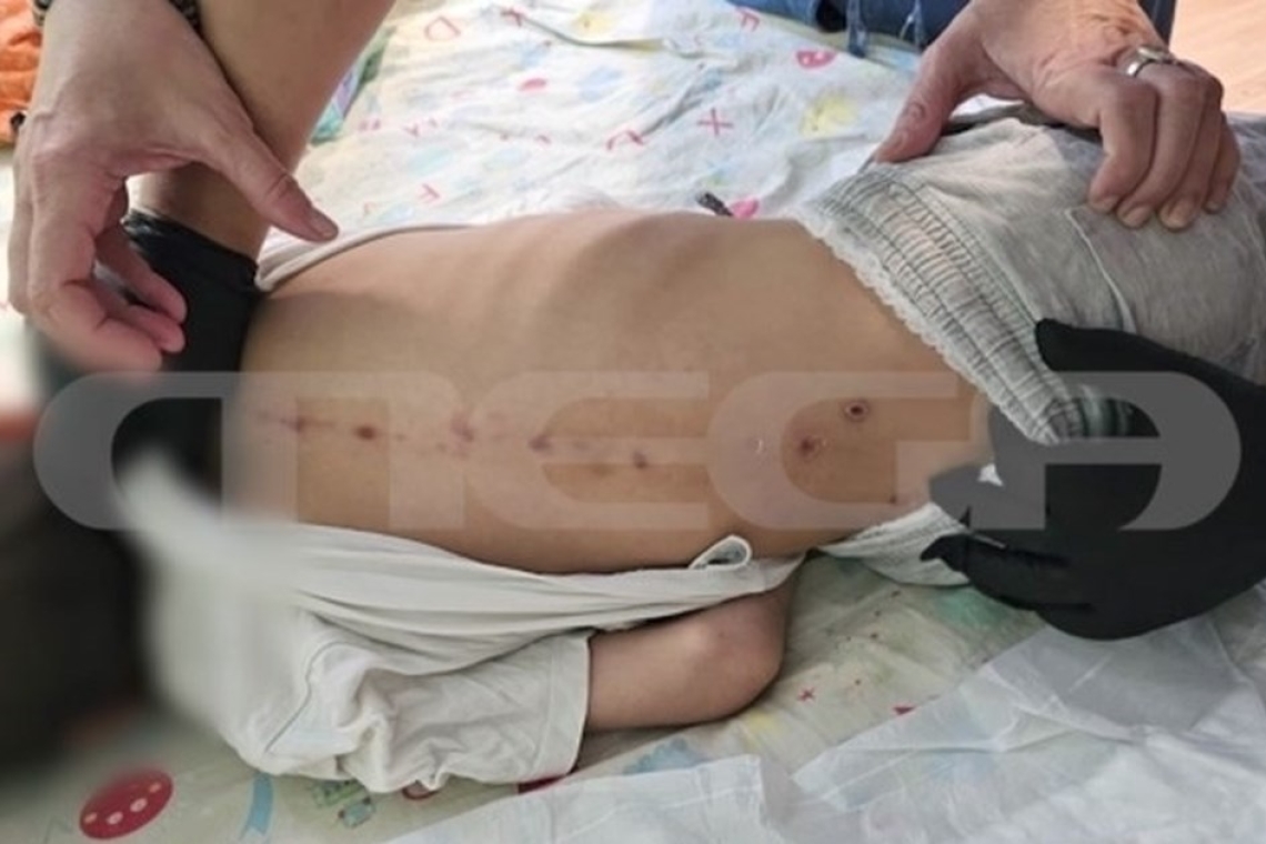 Σημάδια κακοποίησης στην πλάτη 10χρονου στην Πάτρα